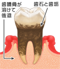 中等度歯周炎