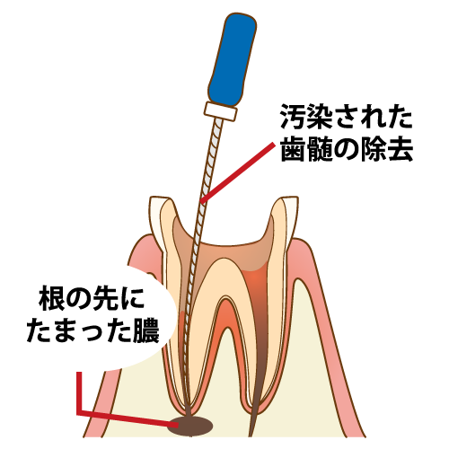 根管治療とは?