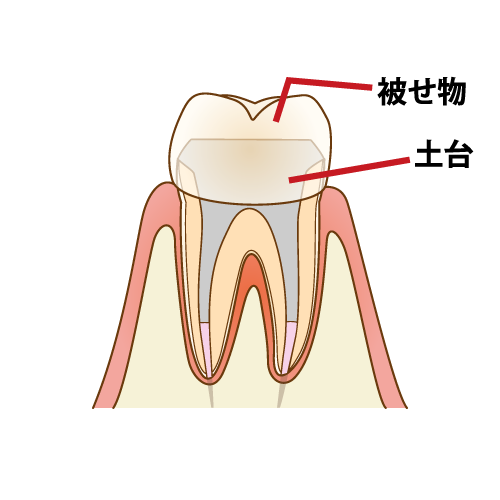 根管治療が重要な理由