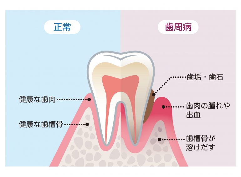 歯周病とは?