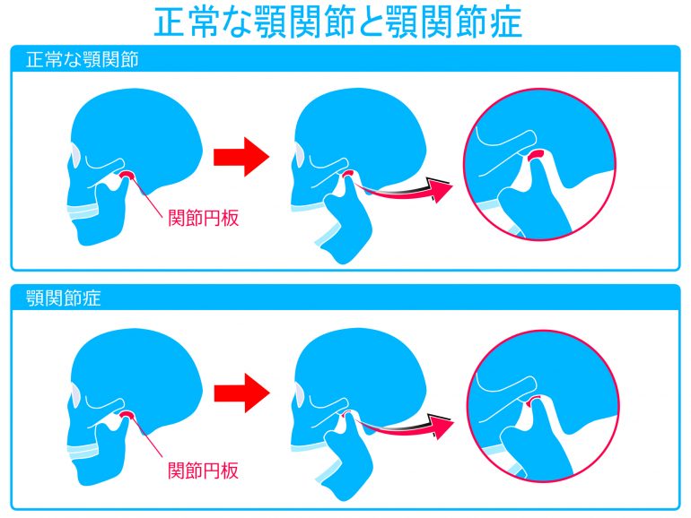 顎関節症とは?