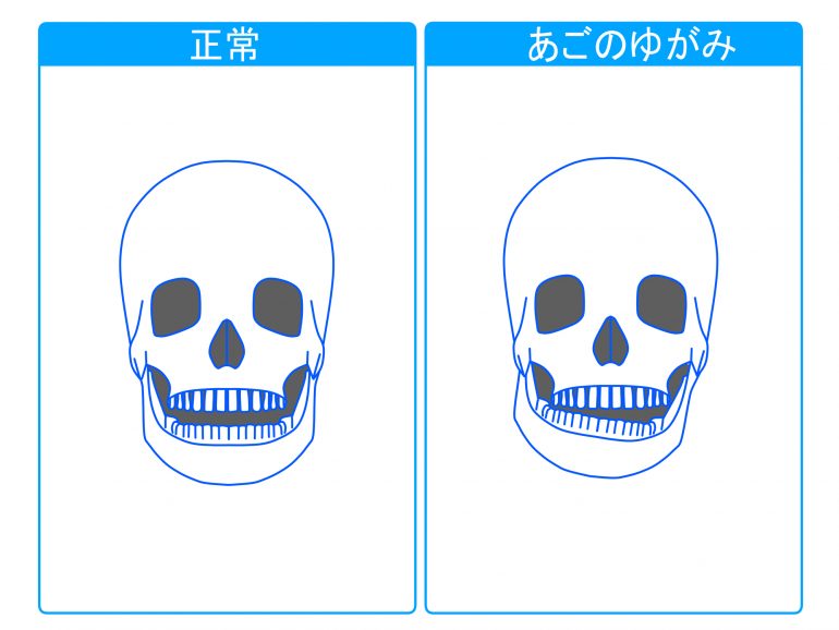 咬み合わせと顎関節症の関係